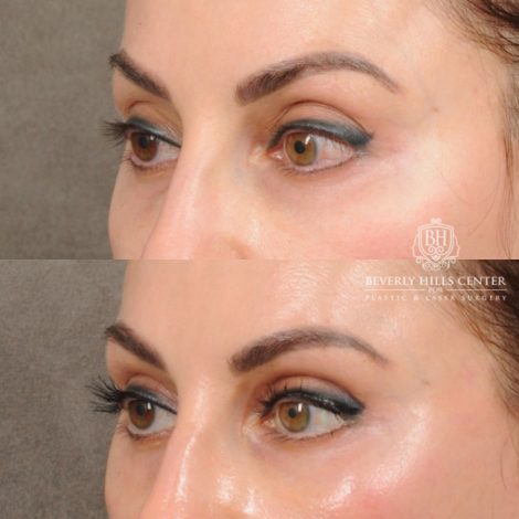 female patient before and after AuraLyft with Upper Bleharoplasty & Ptosis Repair