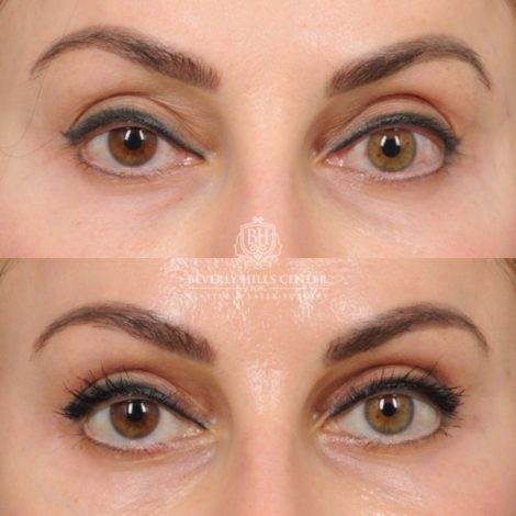 female patient before and after AuraLyft with Upper Bleharoplasty & Ptosis Repair