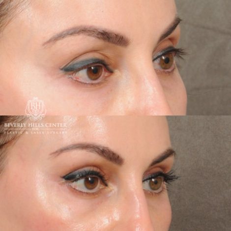 female patient before and after AuraLyft with Upper Bleharoplasty & Ptosis Repair