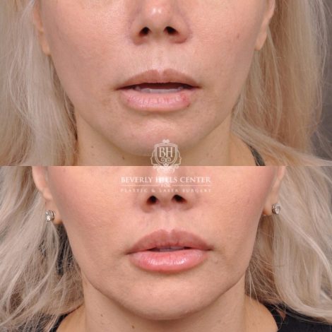 female patient before and after Modified Upper Lip Lift with Deep Plane Release