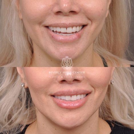 female patient before and after Modified Upper Lip Lift with Deep Plane Release