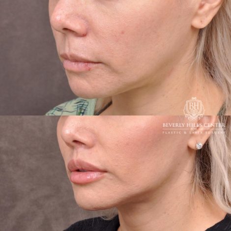 female patient before and after Modified Upper Lip Lift with Deep Plane Release