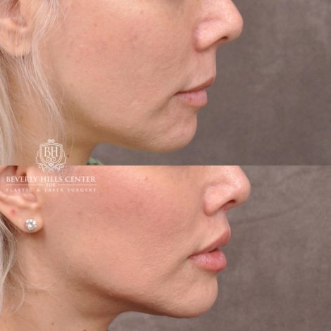 female patient before and after Modified Upper Lip Lift with Deep Plane Release
