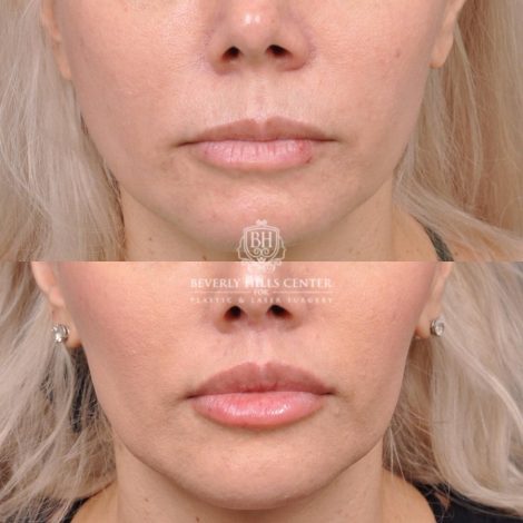 female patient before and after Modified Upper Lip Lift with Deep Plane Release