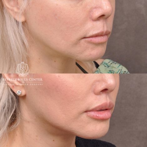 female patient before and after Modified Upper Lip Lift with Deep Plane Release