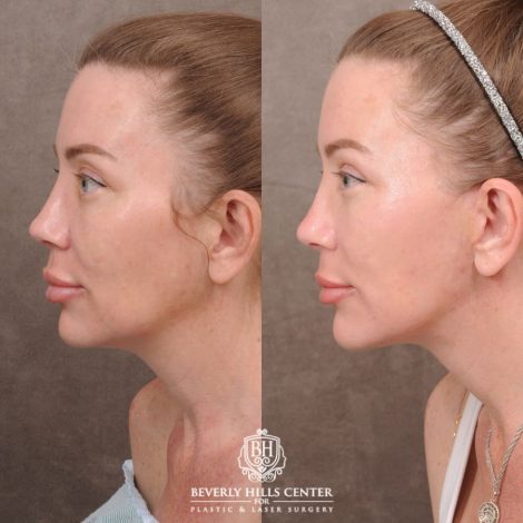 Beverly Hills Center Female Patient Before and After AuraLyft, Upper Blepharoplasty