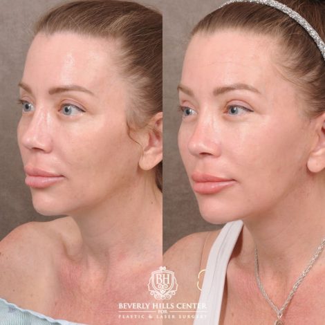 Beverly Hills Center Female Patient Before and After AuraLyft, Upper Blepharoplasty