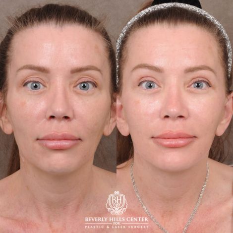 Beverly Hills Center Female Patient Before and After AuraLyft, Upper Blepharoplasty