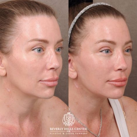 Beverly Hills Center Female Patient Before and After AuraLyft, Upper Blepharoplasty