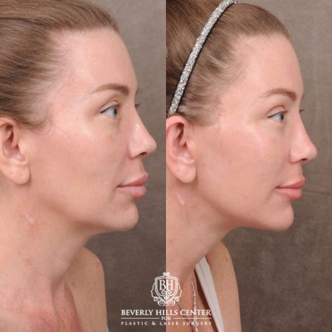 Beverly Hills Center Female Patient Before and After AuraLyft, Upper Blepharoplasty