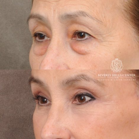 Beverly Hills Center Female Patient Before and After AuraLyft, CUPID LIFT®, Brow Lift, Upper Blepharoplasty