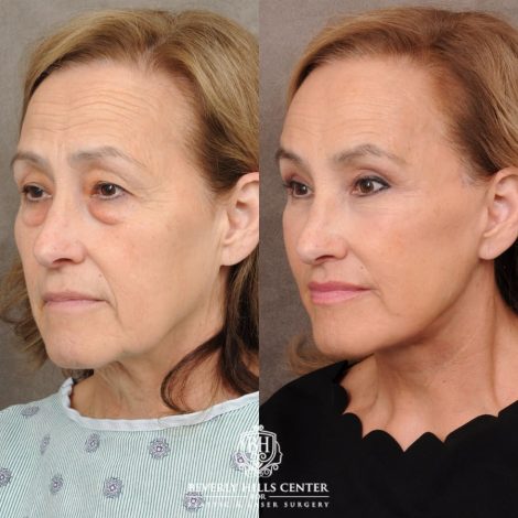 Beverly Hills Center Female Patient Before and After AuraLyft, CUPID LIFT®, Brow Lift, Upper Blepharoplasty
