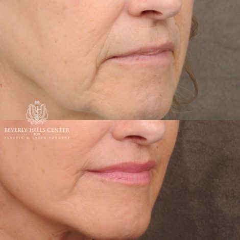 Beverly Hills Center Female Patient Before and After AuraLyft, CUPID LIFT®, Brow Lift, Upper Blepharoplasty