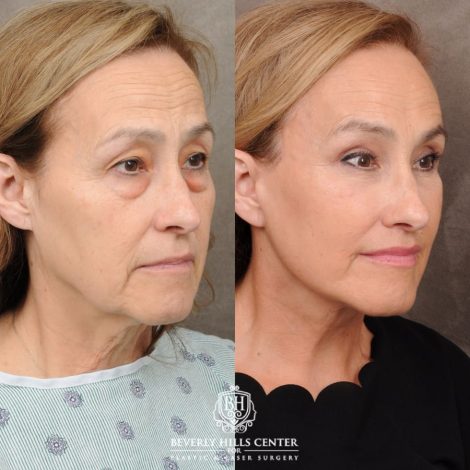 Beverly Hills Center Female Patient Before and After AuraLyft, CUPID LIFT®, Brow Lift, Upper Blepharoplasty
