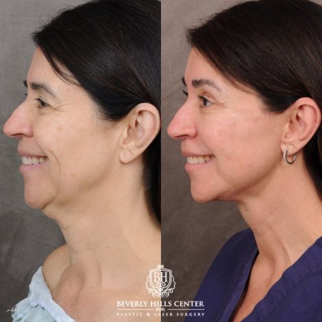 Beverly Hills Center Female Patient Before and After AuraLyft, Brow Lift, Upper Blepharoplasty, Ptosis Repair