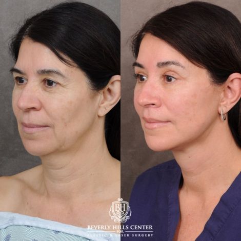 Beverly Hills Center Female Patient Before and After AuraLyft, Brow Lift, Upper Blepharoplasty, Ptosis Repair