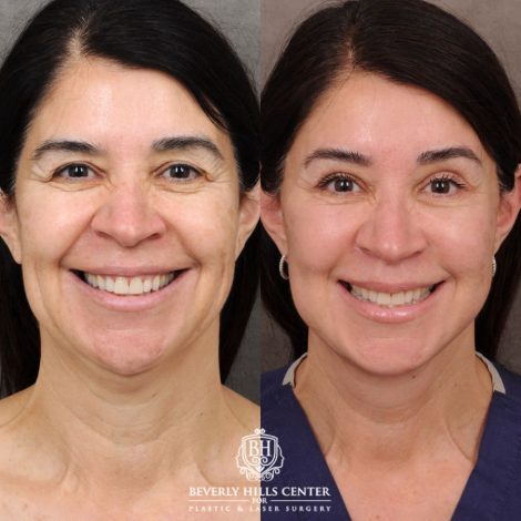 Beverly Hills Center Female Patient Before and After AuraLyft, Brow Lift, Upper Blepharoplasty, Ptosis Repair