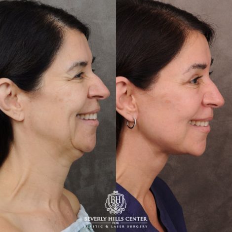 Beverly Hills Center Female Patient Before and After AuraLyft, Brow Lift, Upper Blepharoplasty, Ptosis Repair