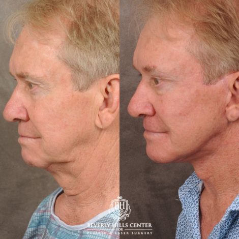 Beverly Hills Center Male Patient Before and After AuraLyft, Brow Lift, Upper Bleph