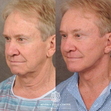 Beverly Hills Center Male Patient Before and After AuraLyft, Brow Lift, Upper Bleph