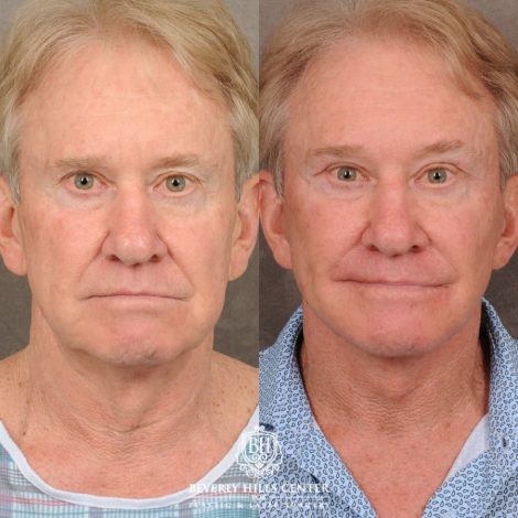 Beverly Hills Center Male Patient Before and After AuraLyft, Brow Lift, Upper Bleph