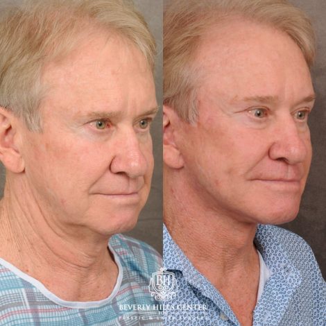 Beverly Hills Center Male Patient Before and After AuraLyft, Brow Lift, Upper Bleph