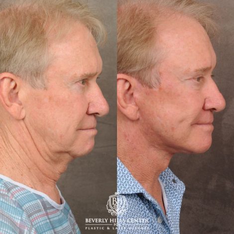 Beverly Hills Center Male Patient Before and After AuraLyft, Brow Lift, Upper Bleph