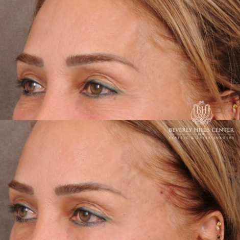 Beverly Hills Center Female Patient Before and After Temple Fillers