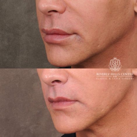 Beverly Hills Center Male Patient Before and After LIP LIFT
