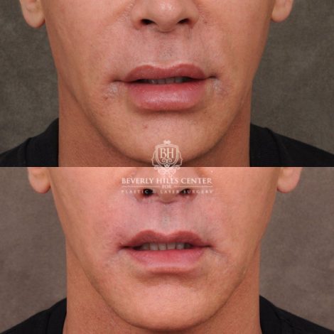 Beverly Hills Center Male Patient Before and After LIP LIFT