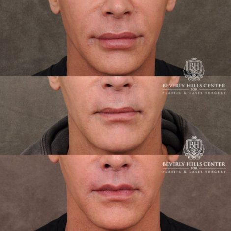Beverly Hills Center Male Patient Before and After LIP LIFT