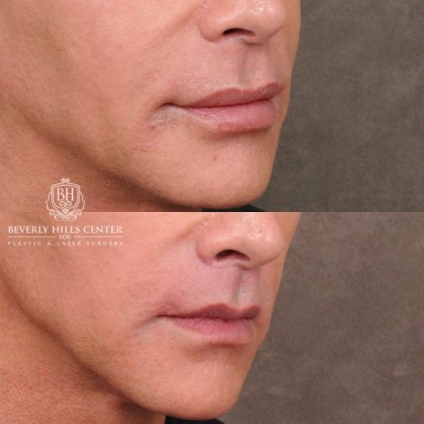 Beverly Hills Center Male Patient Before and After LIP LIFT
