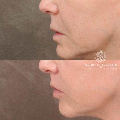 Beverly Hills Center Female Patient Before and After CUPID LIFT® Corner Lift