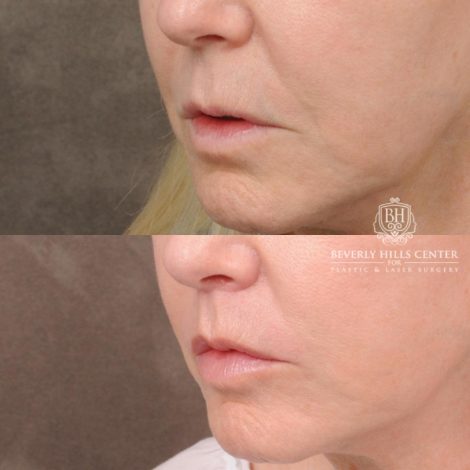 Beverly Hills Center Female Patient Before and After CUPID LIFT® Corner Lift