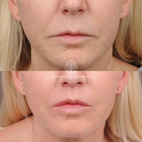 Beverly Hills Center Female Patient Before and After CUPID LIFT® Corner Lift