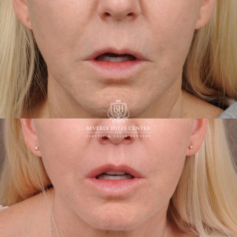 Beverly Hills Center Female Patient Before and After CUPID LIFT® Corner Lift