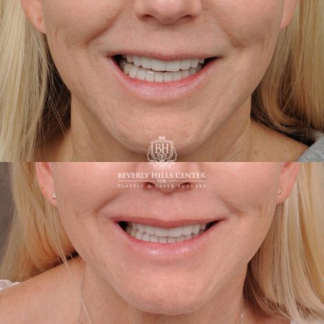 Beverly Hills Center Female Patient Before and After CUPID LIFT® Corner Lift
