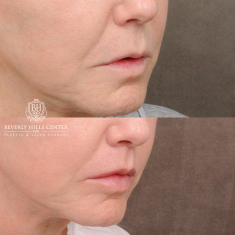 Beverly Hills Center Female Patient Before and After CUPID LIFT® Corner Lift