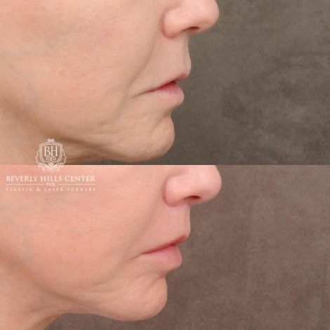 Beverly Hills Center Female Patient Before and After CUPID LIFT® Corner Lift
