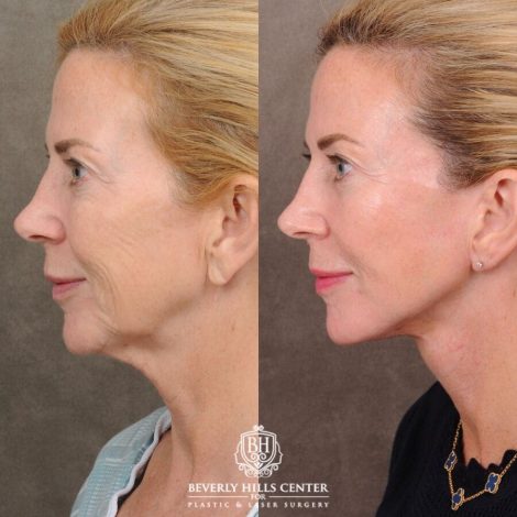 Beverly Hills Center Female Patient Before and After AuraLyft with Nanofat PRP