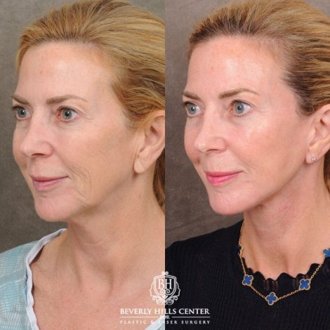 Beverly Hills Center Female Patient Before and After AuraLyft with Nanofat PRP