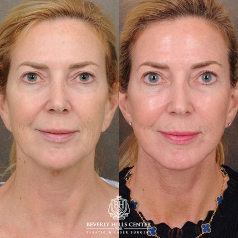 Beverly Hills Center Female Patient Before and After AuraLyft with Nanofat PRP
