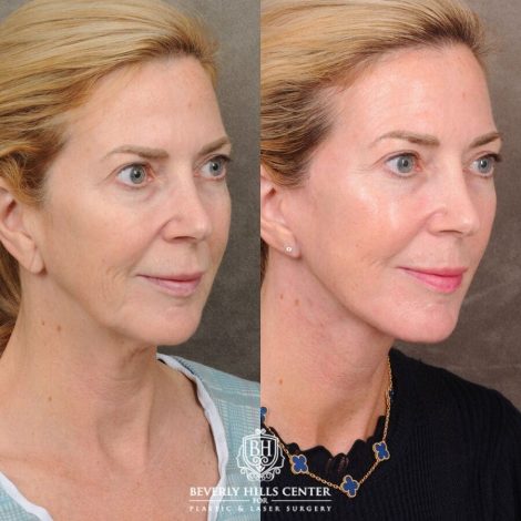 Beverly Hills Center Female Patient Before and After AuraLyft with Nanofat PRP
