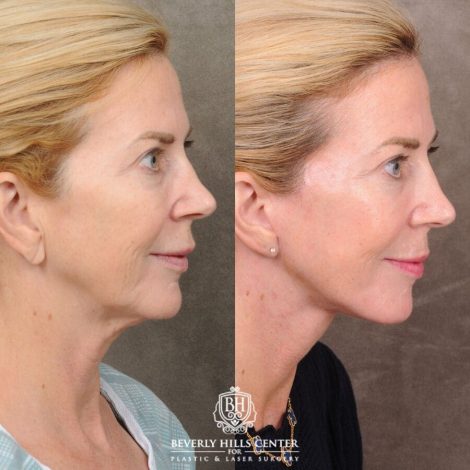 Beverly Hills Center Female Patient Before and After AuraLyft with Nanofat PRP