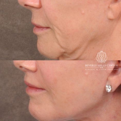 Beverly Hills Center Female Patient Before and After Comprehensive AuraLyft with CUPID LIFT® Corner Lift