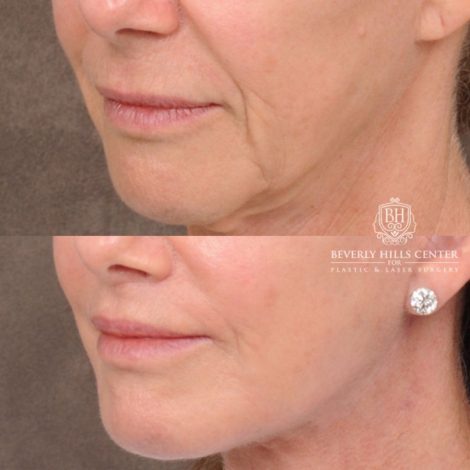 Beverly Hills Center Female Patient Before and After Comprehensive AuraLyft with CUPID LIFT® Corner Lift