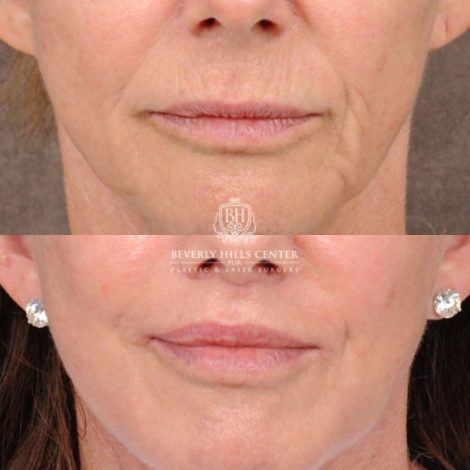 Beverly Hills Center Female Patient Before and After Comprehensive AuraLyft with CUPID LIFT® Corner Lift