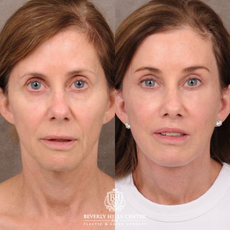 Beverly Hills Center Female Patient Before and After Comprehensive AuraLyft with CUPID LIFT® Corner Lift