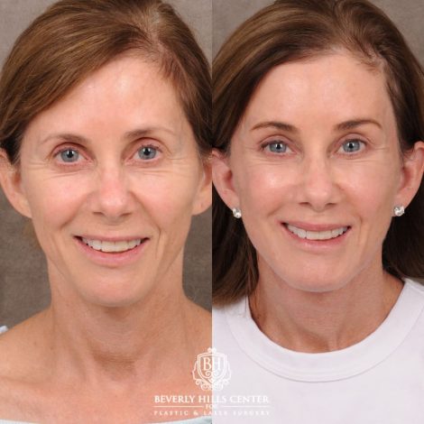Beverly Hills Center Female Patient Before and After Comprehensive AuraLyft with CUPID LIFT® Corner Lift