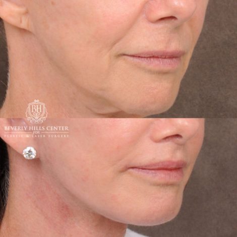 Beverly Hills Center Female Patient Before and After Comprehensive AuraLyft with CUPID LIFT® Corner Lift